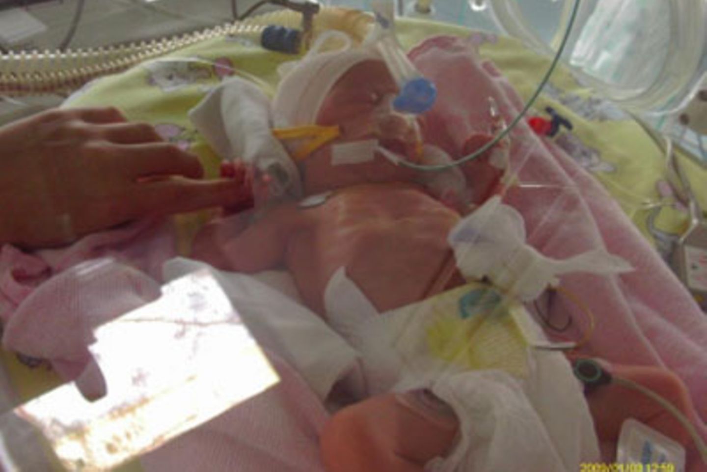 Alicia - 8 Wochen zu früh geboren