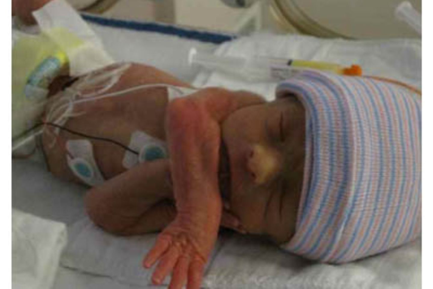 Simon - 11 Wochen zu früh geboren
