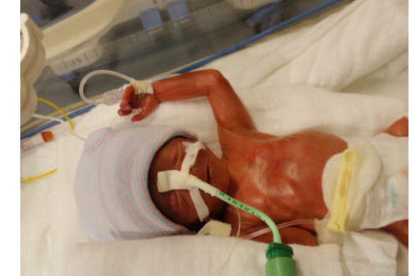 Julian - 14 Wochen zu früh geboren