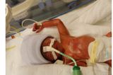 Julian - 14 Wochen zu früh geboren
