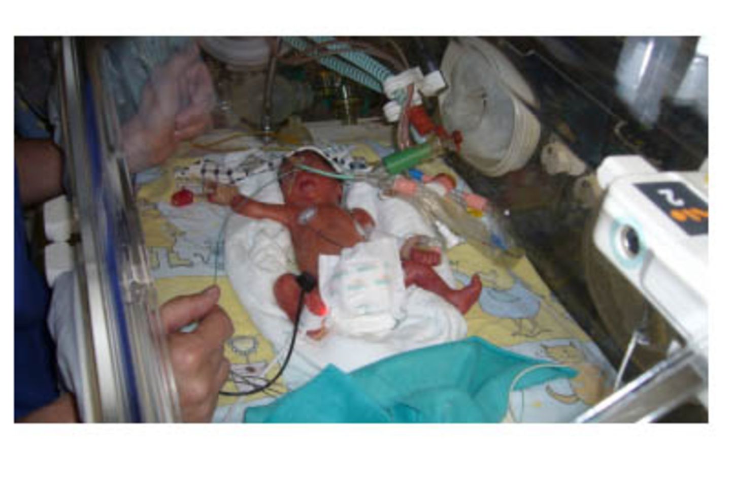 Amy-Felia - 12 Wochen zu früh geboren
