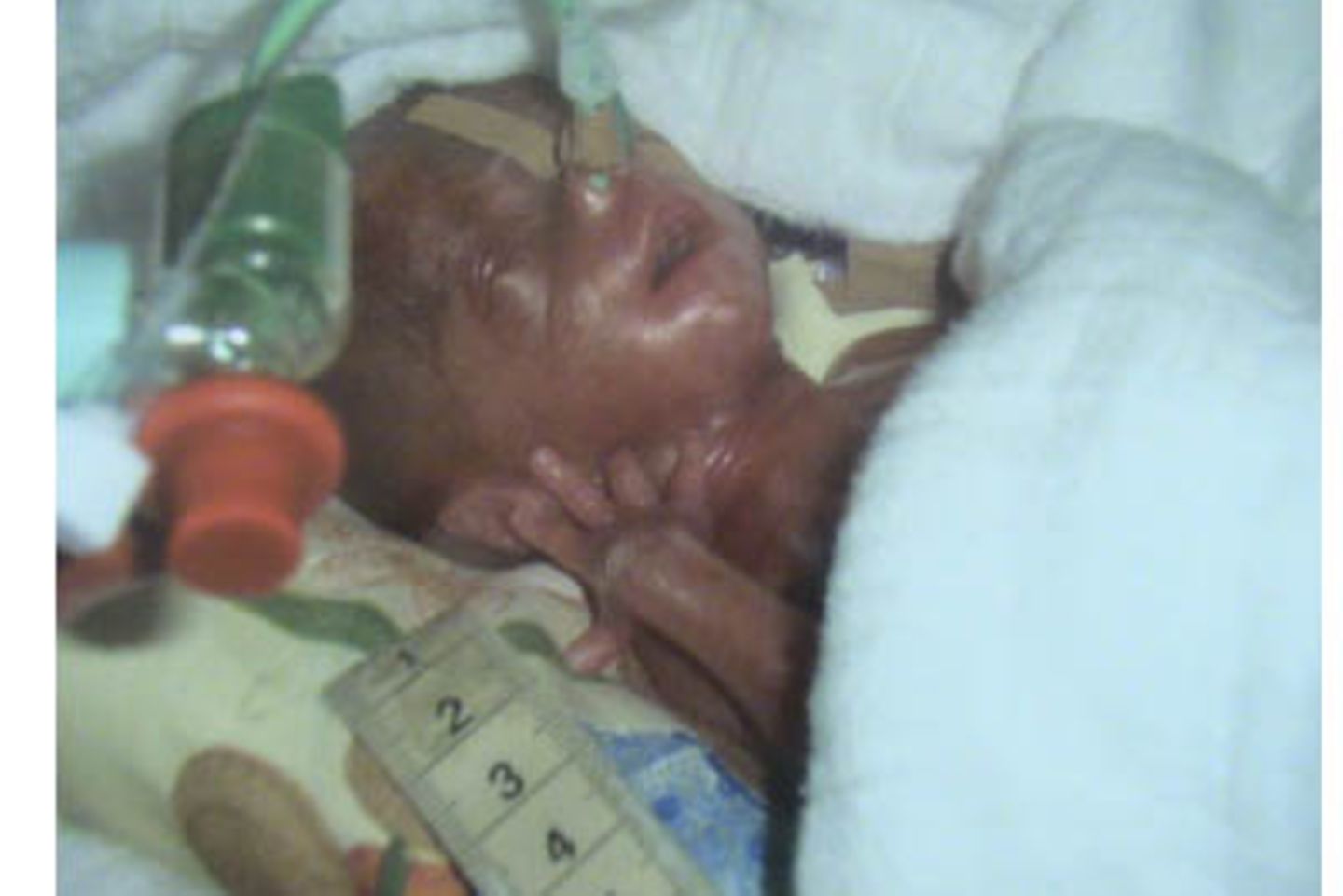Unser kleines Wunder - 16 Wochen zu früh geboren