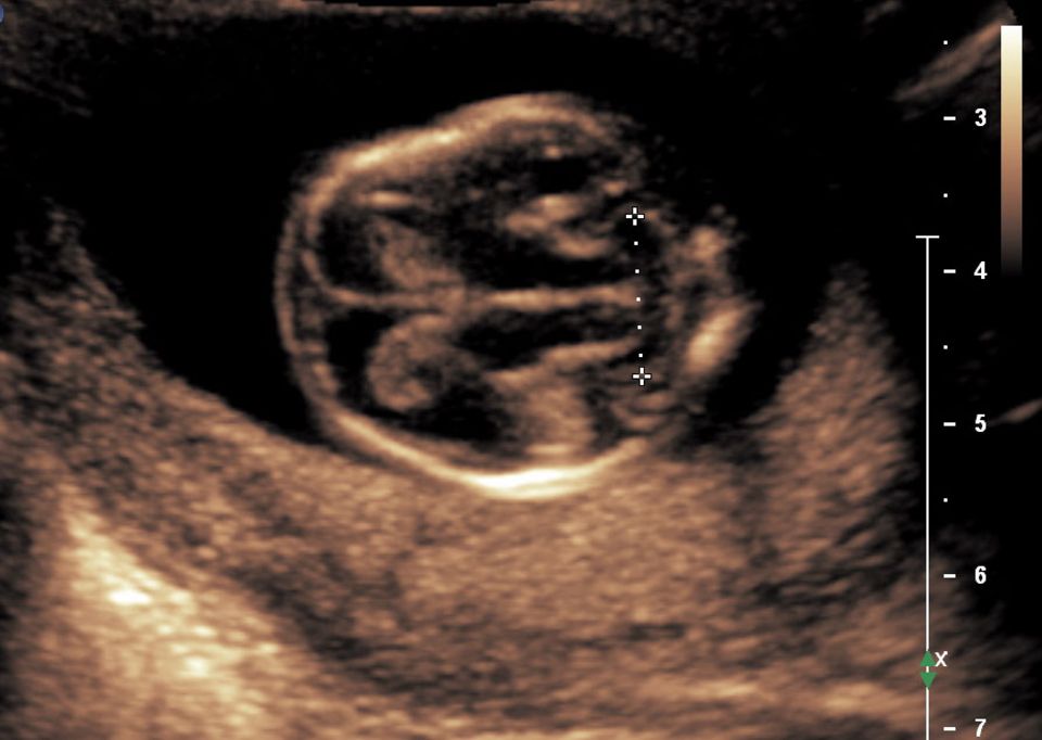 Kleinhirn eines Embryos in SSW 13