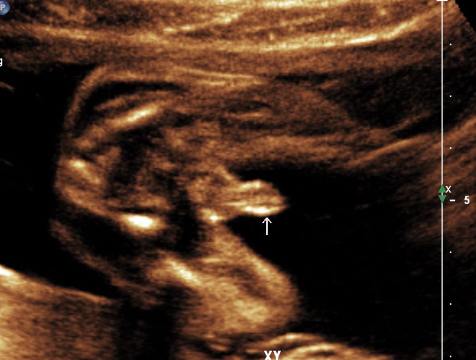 Ultraschallbild eines Jungen in SSW 20