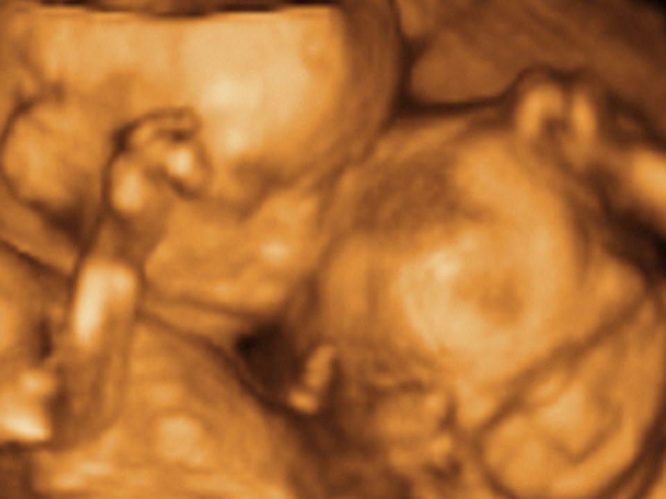 3D-Ultraschallbild von Zwillingen