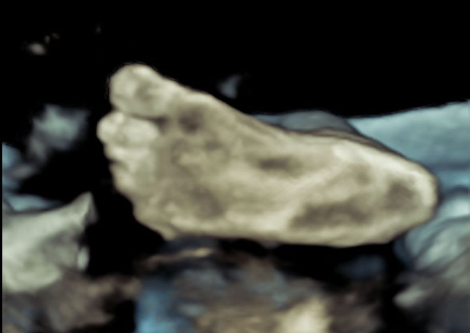 3D-Ultraschall vom Fuß