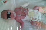 Matilda geboren in der 24 ssw mit 33 cm und 660g