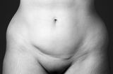 Kaiserschnittnarbe: So unterschiedlich sehen Kaiserschnittnarben aus