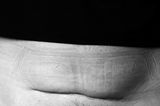 Kaiserschnittnarbe: So unterschiedlich sehen Kaiserschnittnarben aus