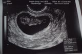 Ultraschallbild Baby in der 8. SSW