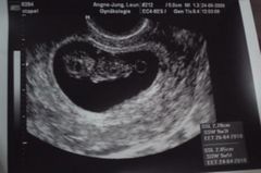 12 junge ultraschall ssw Ultraschallbild Mädchen