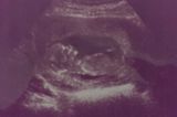 Ultraschallbild Baby: Mein kleiner Schatz