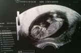Ultraschallbild Baby: Unsere kleine Prinzessin