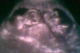 Ultraschallbild Baby: Eindeutig Doppelpack