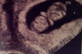 Ultraschallbild Baby: Unser kleines Würmchen