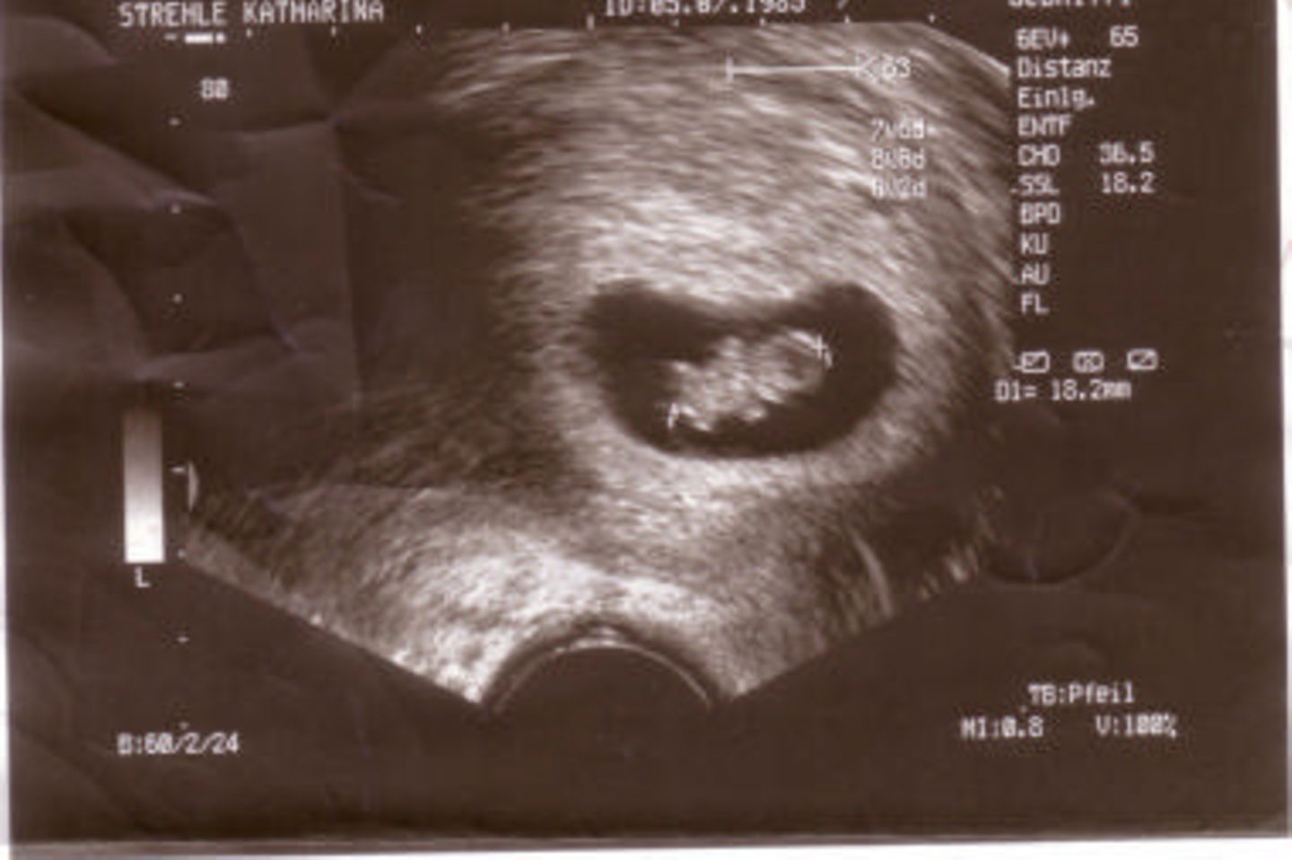 Ultraschallbild Baby: Mein erstes Bild!