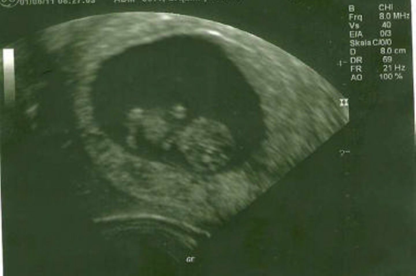 Ultraschallbild Baby: Endlich kann man was erkennen!
