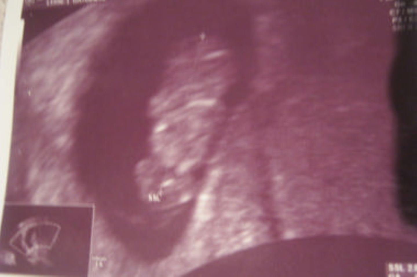 Ultraschallbild Baby: Unser Gummibär