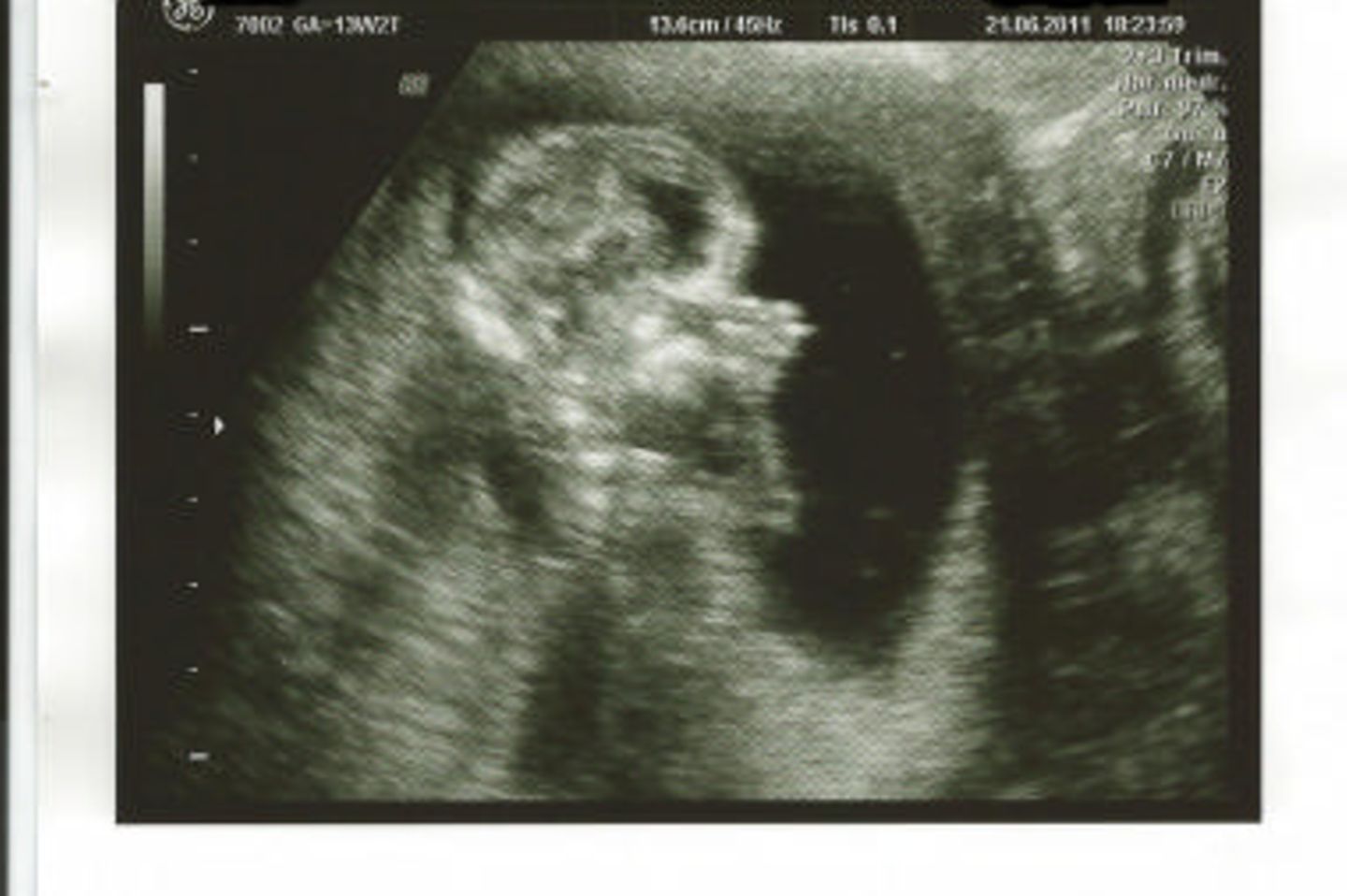 Ultraschallbild Baby