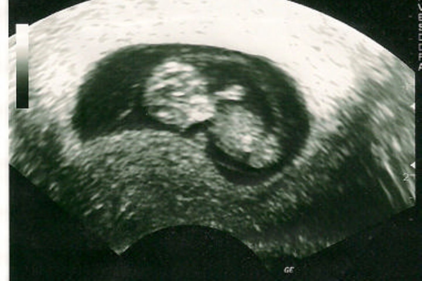 Ultraschallbild von Baby: Schon so groß!