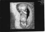 Ultraschallbild Baby: Unser Purzel in der 12. SSW