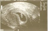 Ultraschallbild Baby: Endlich hat es geklappt