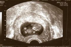 Ultraschallbild Baby in der 11. SSW