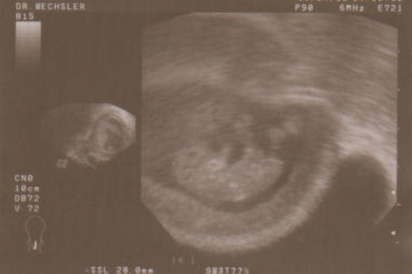 Ultraschallbild Baby: Unser Würmchen in der 9. SSW