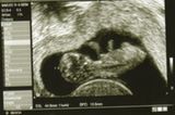 Ultraschallbild Baby: 10+5 Woche