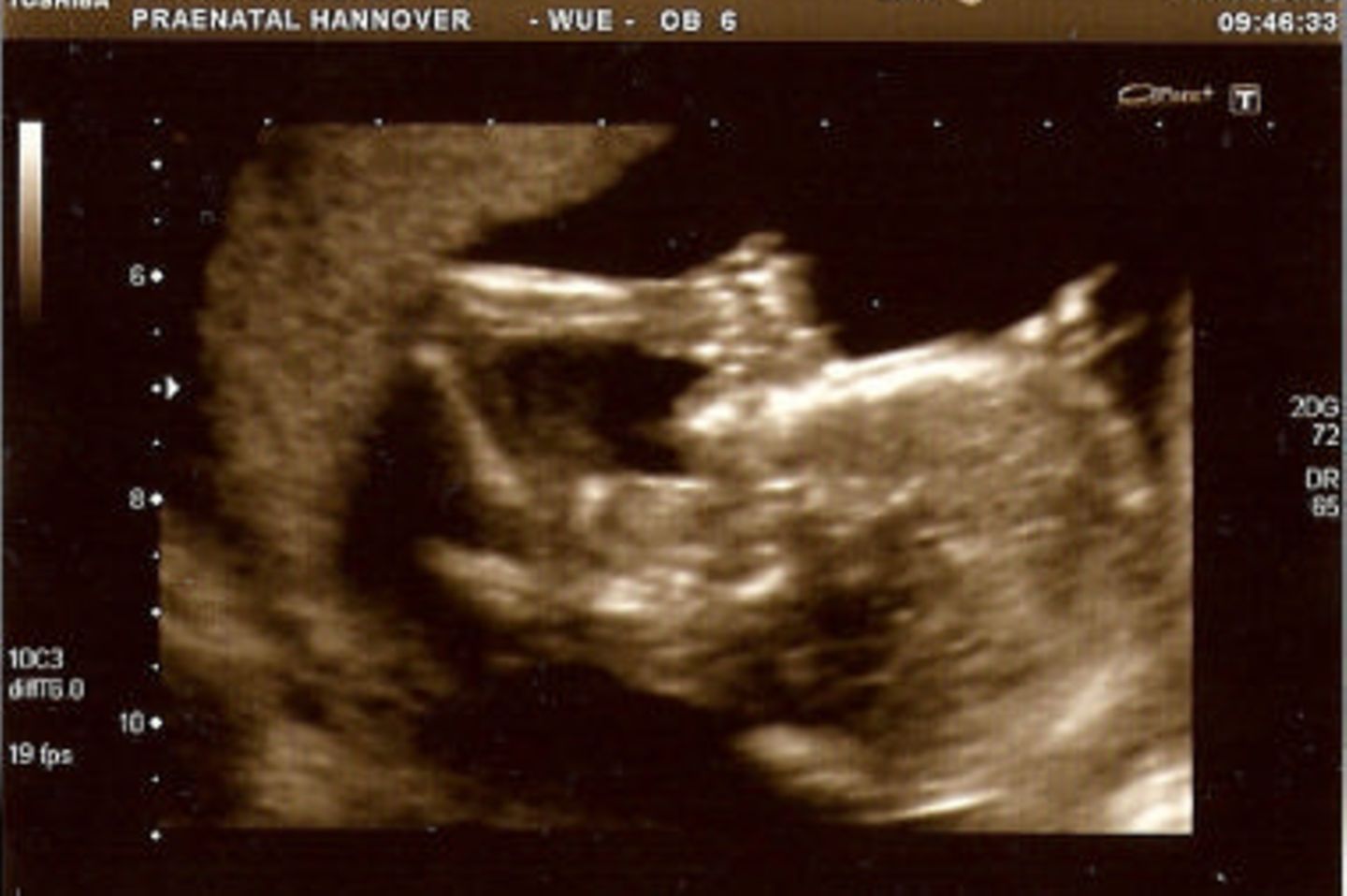 Ultraschallbild Baby