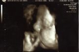 Ultraschallbild von Baby