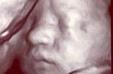 3D-Ultraschallbild von Mika in der 31. SSW