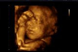 Ultraschallbild von Baby