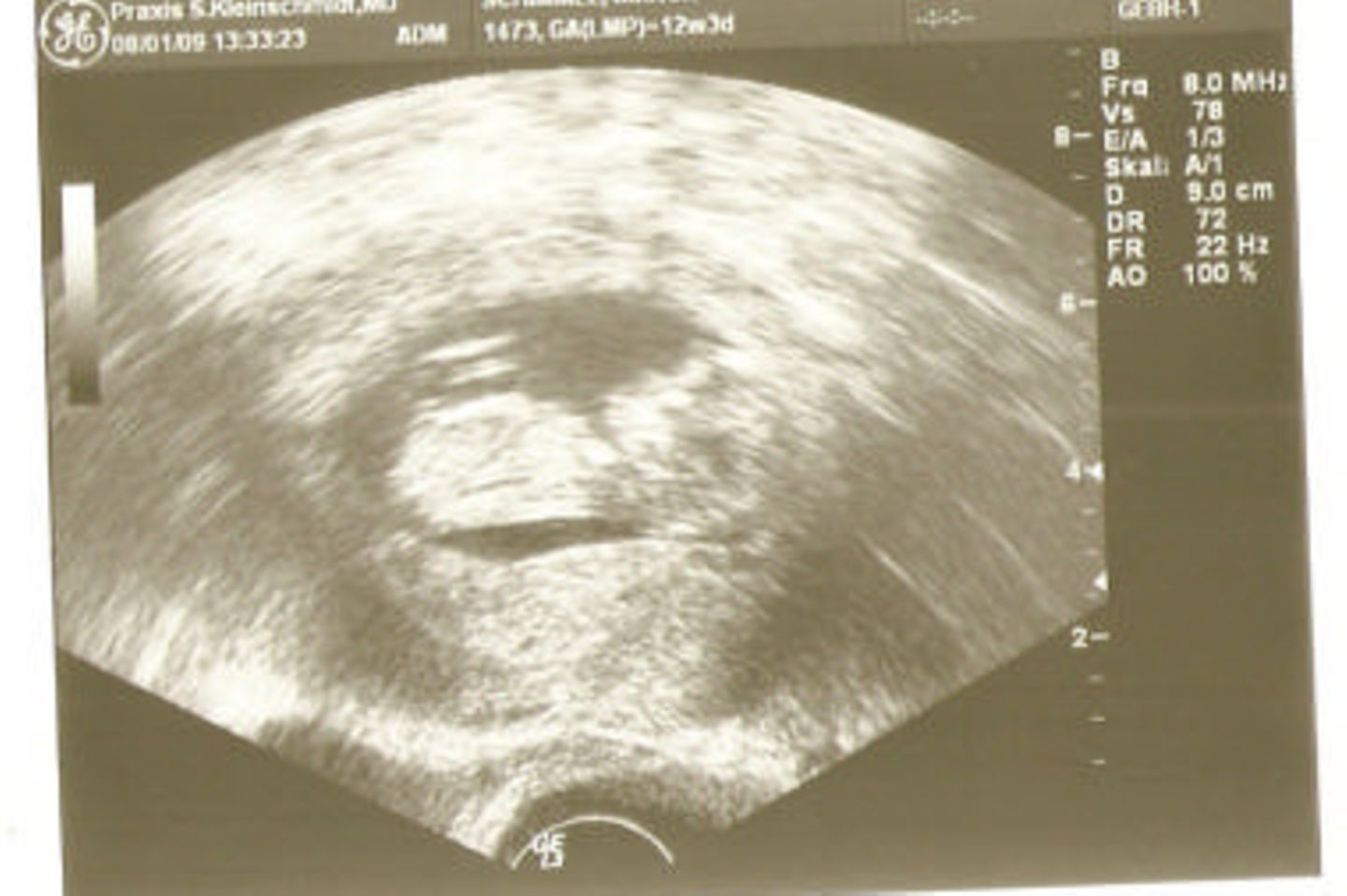 Ultraschallbild Baby: Mein Baby in der 12. SSW
