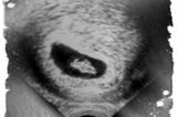Ultraschallbild Baby: Endlich schwanger!