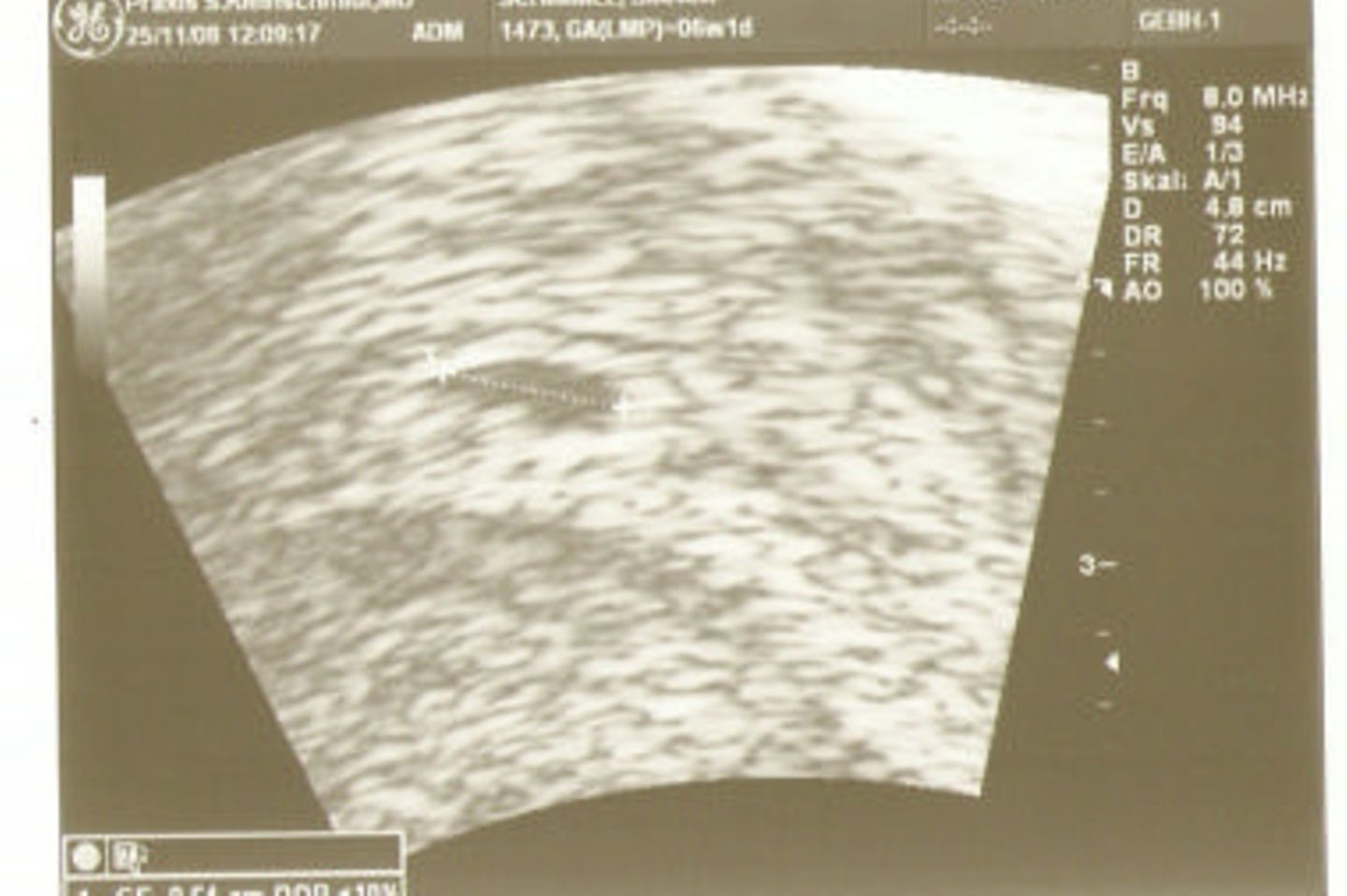 Ultraschallbild Baby: Krümmel in der 6. SSW