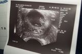 Ultraschallbild Baby: Unser Würmli, 8+0 SSW