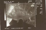 Ultraschallbild vom Baby im ersten Trimester: Unser Pünktchen