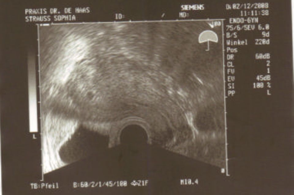 Ultraschallbild vom Baby im ersten Trimester: Unser Pünktchen