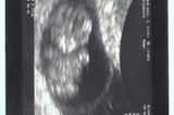 Ultraschallbild von Baby: Unser Schatz