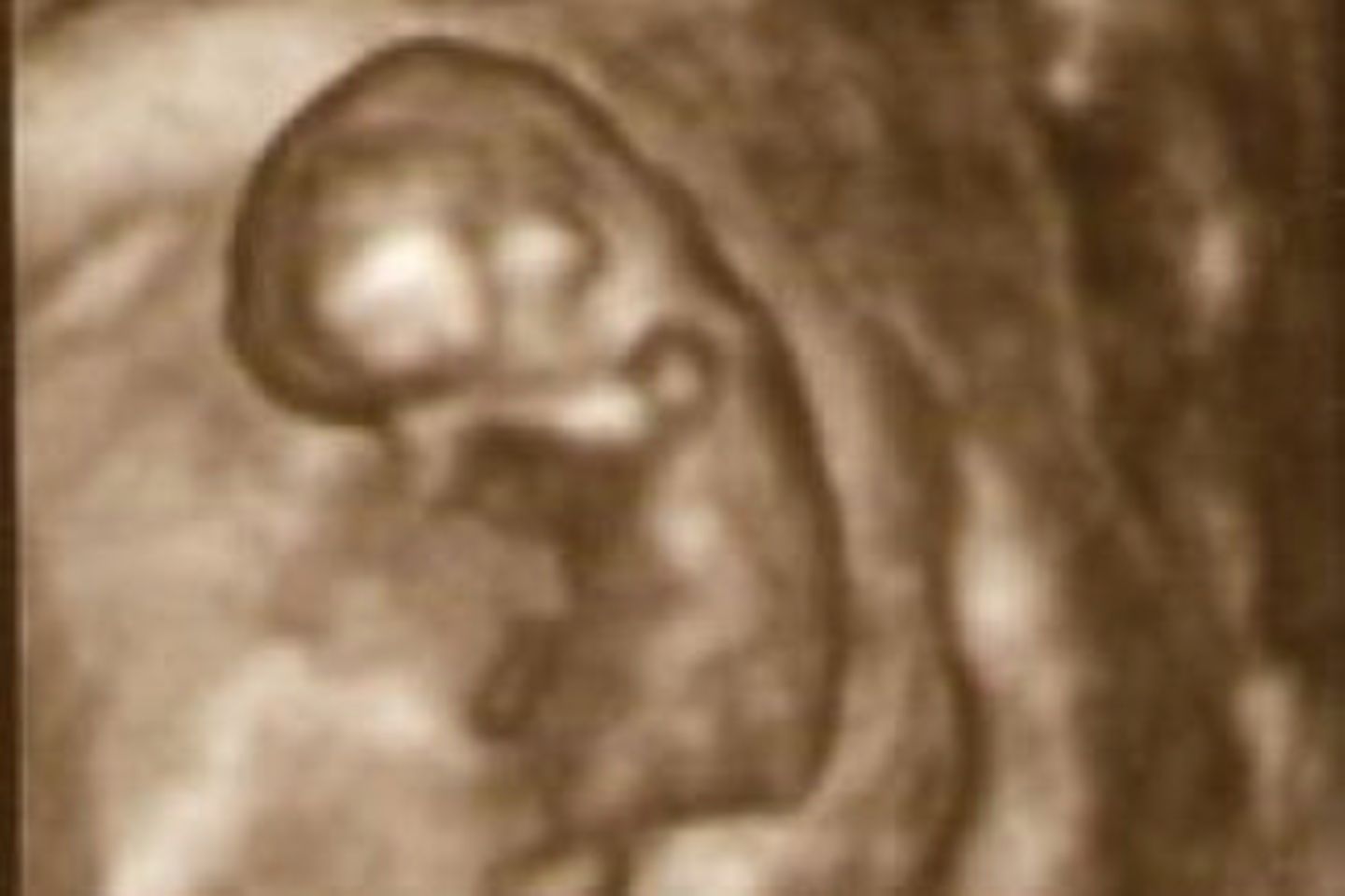 Ultraschallbild Baby: Juhu – 12. SSW