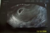 Ultraschallbild von Baby in der 5. SSW