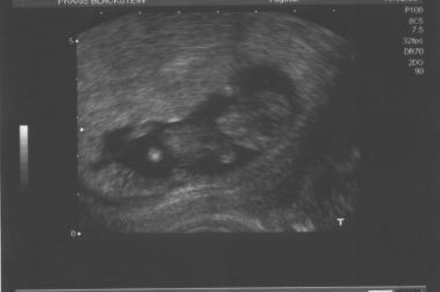 Ultraschallbild Baby: Erstes Foto