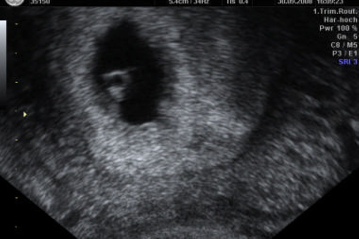 Ultraschallbild von Baby: Es hat geklappt