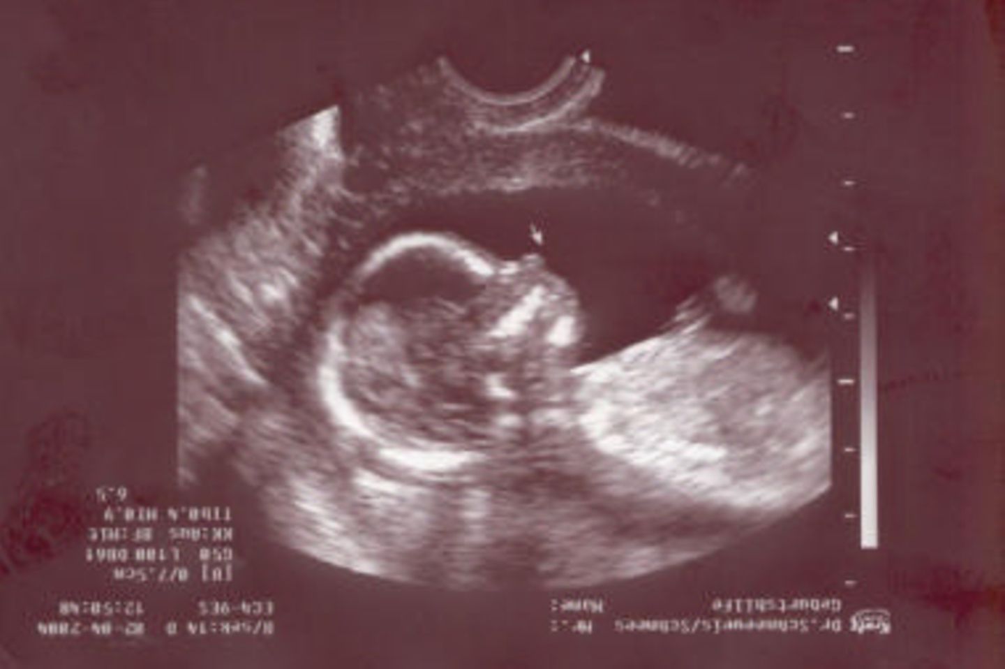 Ultraschallbild Baby
