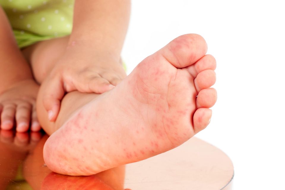 Hand-Fuß-Mund-Krankheit: Ausschlag an Fußsohle