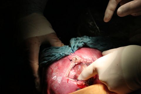 Spina-Bifida-Operation