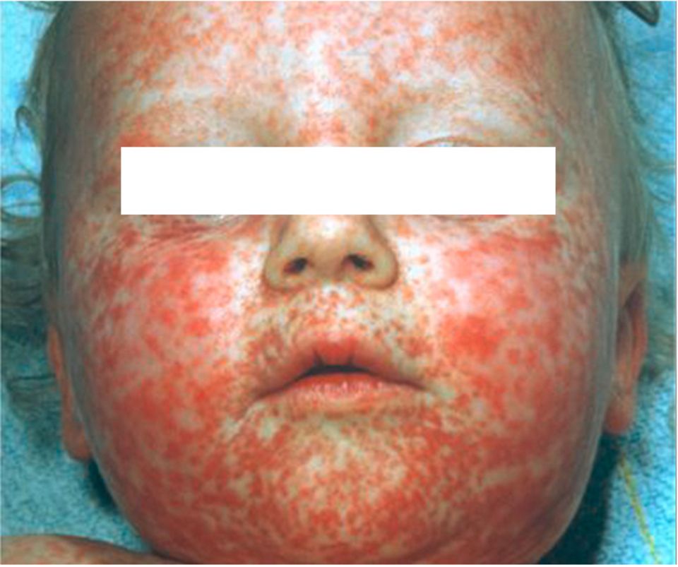Gesicht von Baby mit Masern Gesicht von Baby mit Masern