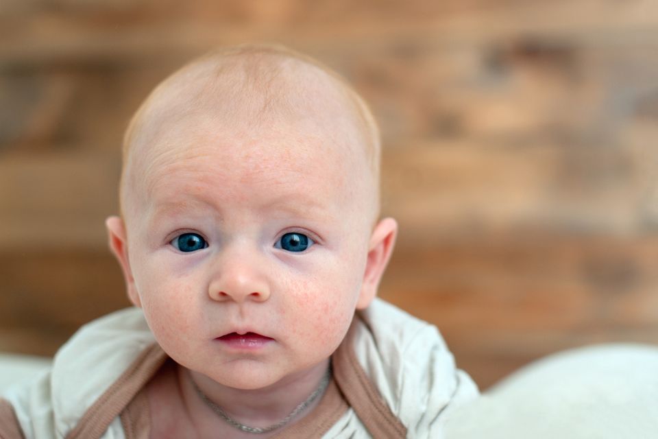 Kleines Baby mit Neurodermitis im Gesicht