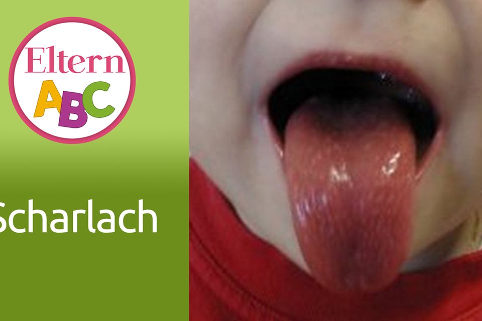Scharlach